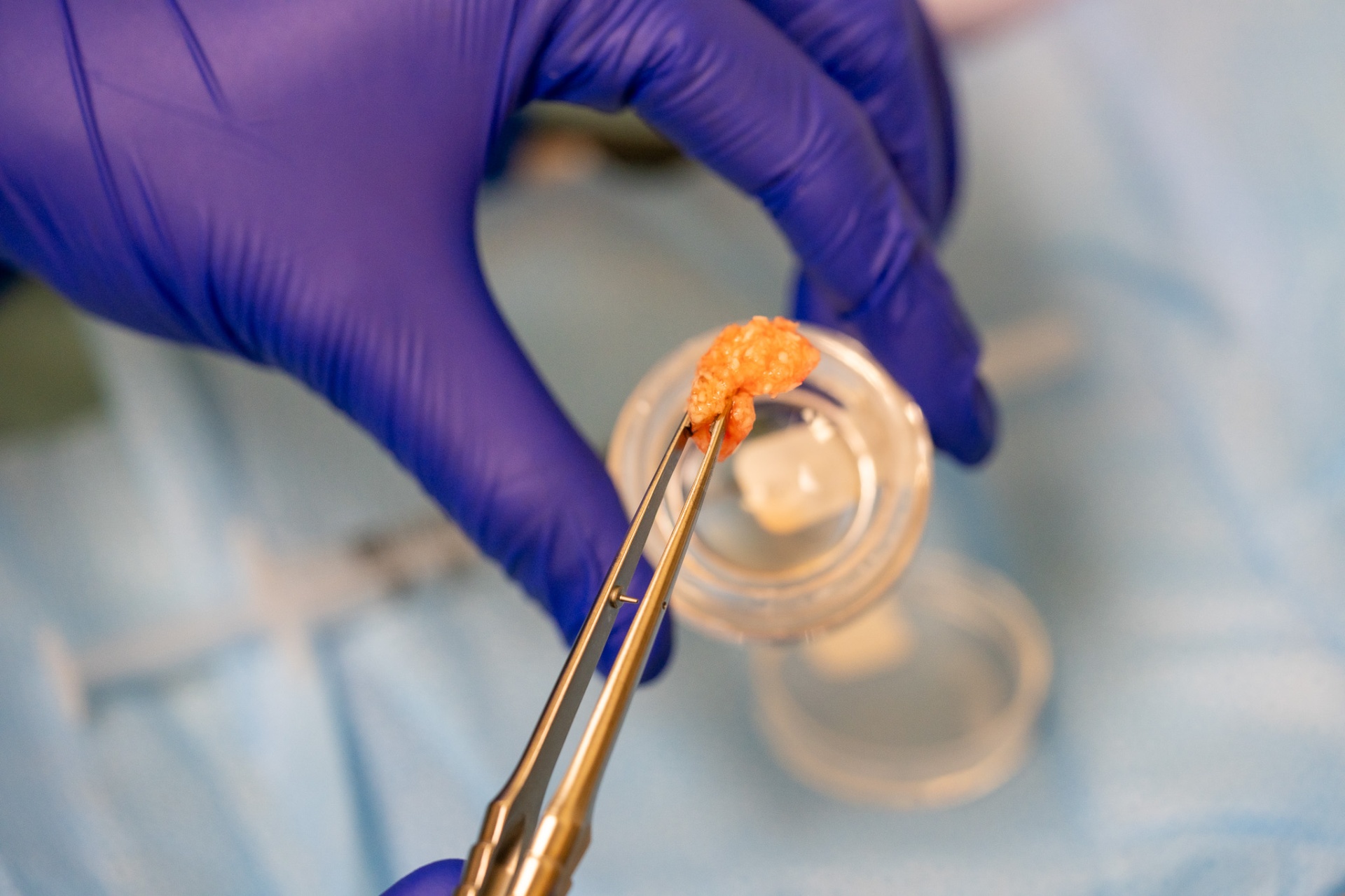 Platelet rich fibrin sample held with surgical forceps after centrifuge preparation