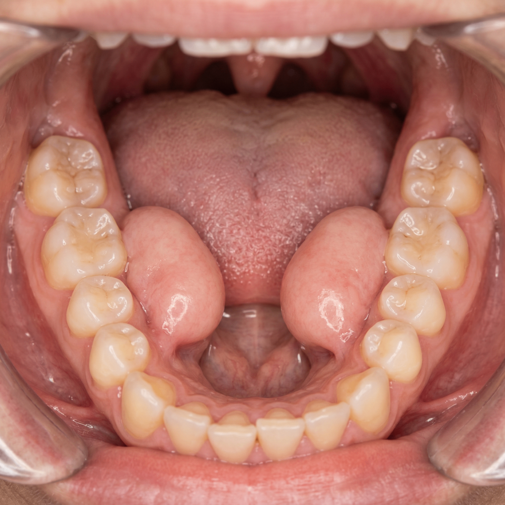 Mandibular tori — bony growths on the floor of the mouth